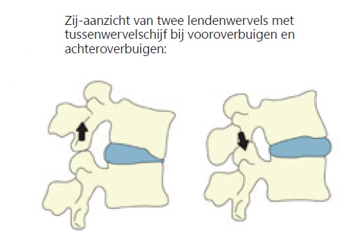 Monteur Uitdrukkelijk Montgomery Artrose in de rug en nek | Artrose Zorg