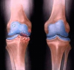 Knie met artrose