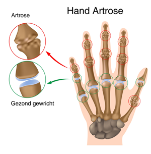 artrose vaststellen
